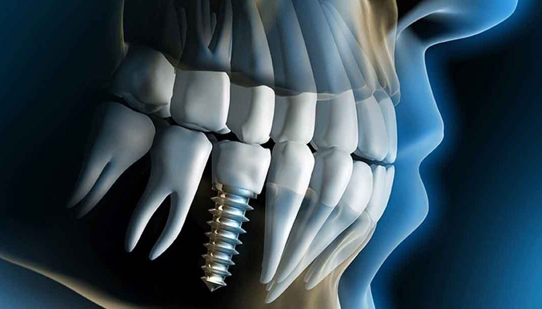 How much do dental implant cost in Tijuana?