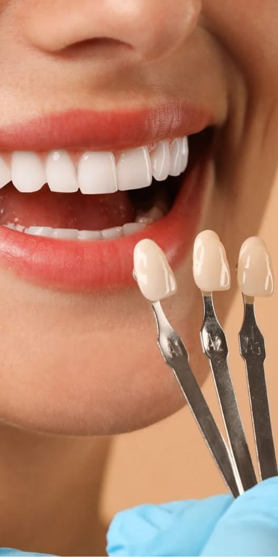 Dental veneers