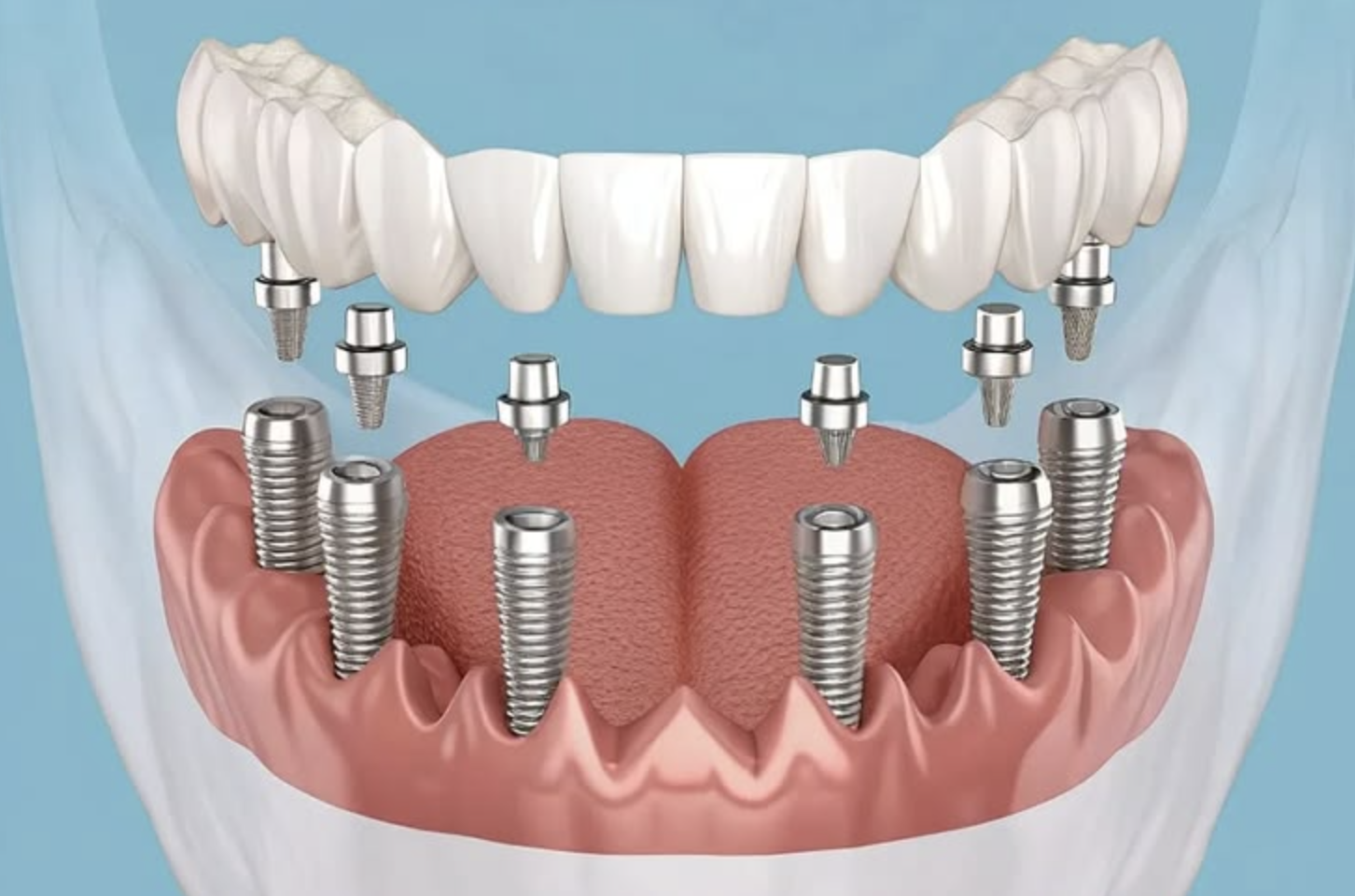 All-on-4 & Full-Arch Implants All-on-4 & Full-Arch Implants