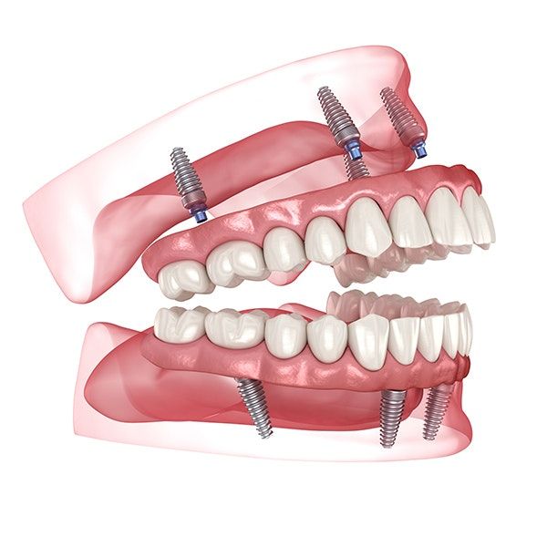 All-on-4 & Full-Arch Implants All-on-4 & Full-Arch Implants