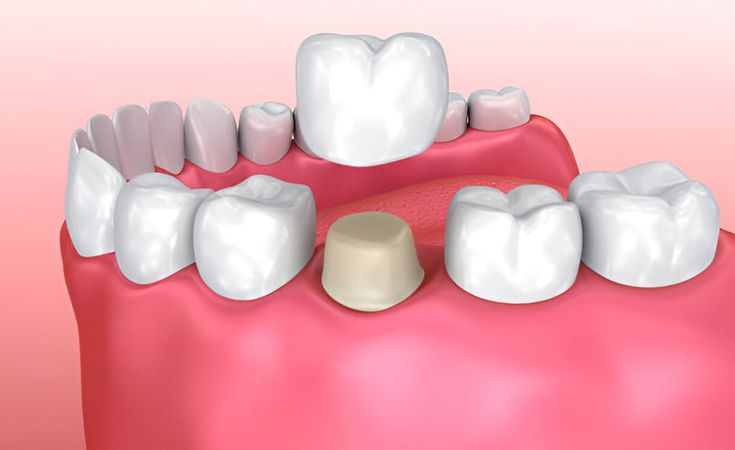 Dental Crowns Dental Crowns