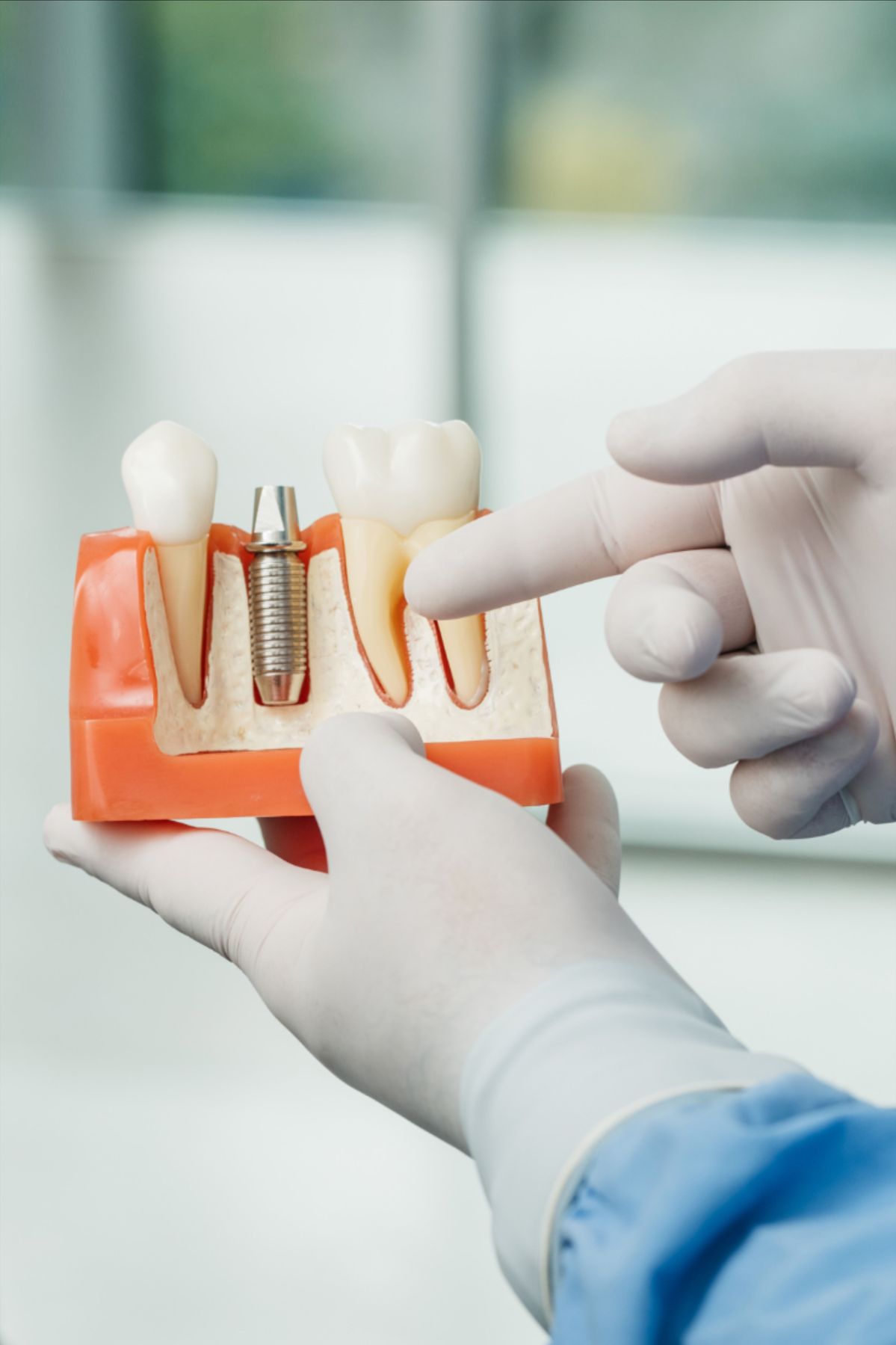 Dental Implants Dental Implants