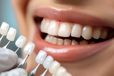 Dental veneers