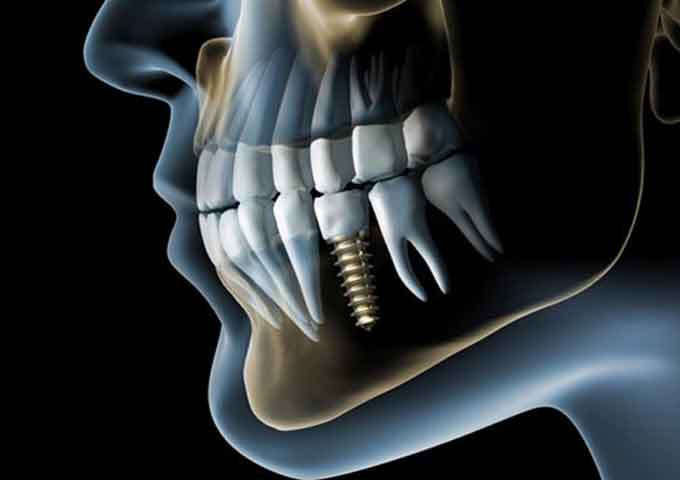 How much do dental implant cost in Tijuana?