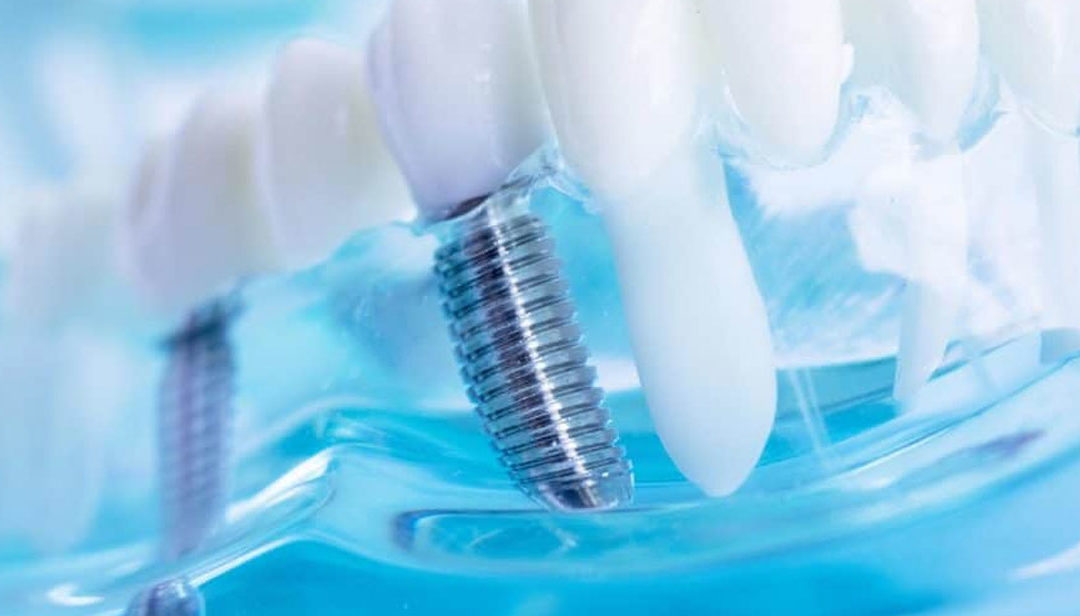 FAQ – All About Dental Implants in Tijuana
